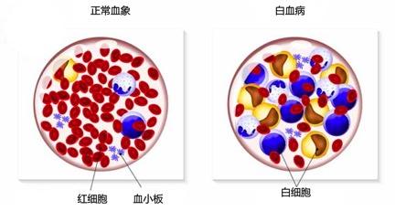 甲醛檢測機(jī)構(gòu)告訴你甲醛與白血病之間有著怎樣的聯(lián)系